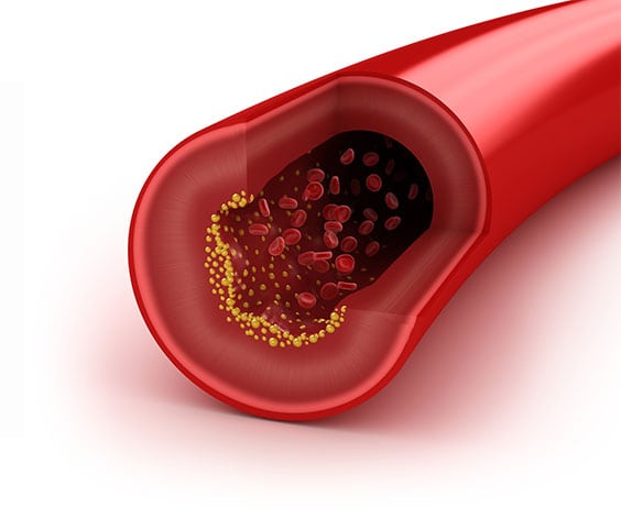 Lipid Corona Pathology 2 - Lipid Lipid Corona Pathology 2 - Lipid