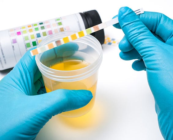 Urinalysis Corona Pathology 1 - Urinalysis Urinalysis Corona Pathology 1 - Urinalysis
