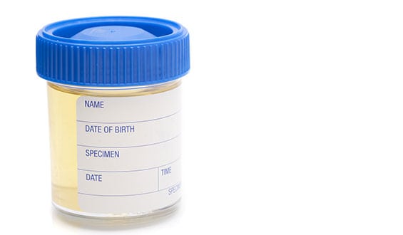 Urinalysis Corona Pathology - Urinalysis Urinalysis Corona Pathology - Urinalysis