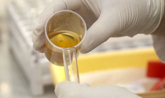 Urinalysis Laboratory in Los Angeles Corona Pathology 1 - Urinalysis Laboratory in Los Angeles Urinalysis Laboratory in Los Angeles Corona Pathology 1 - Urinalysis Laboratory in Los Angeles
