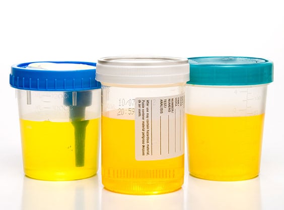 Urinalysis Laboratory in Los Angeles Corona Pathology 2 - Urinalysis Laboratory in Los Angeles Urinalysis Laboratory in Los Angeles Corona Pathology 2 - Urinalysis Laboratory in Los Angeles