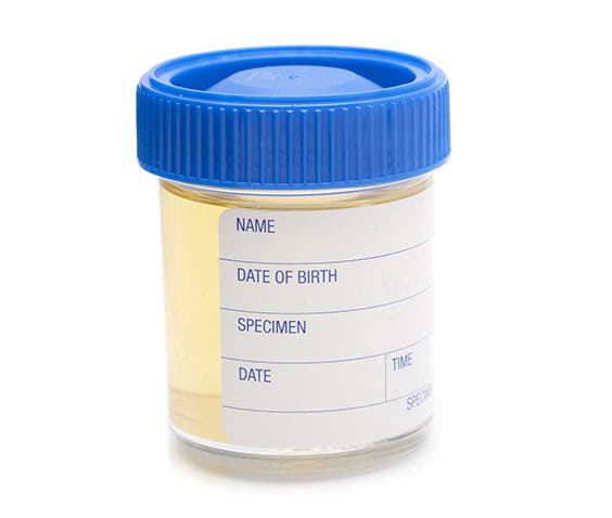 Urinalysis Laboratory in Los Angeles Corona Pathology 3 - Urinalysis Laboratory in Los Angeles Urinalysis Laboratory in Los Angeles Corona Pathology 3 - Urinalysis Laboratory in Los Angeles